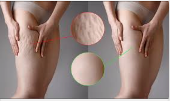 Stretch Marks vs Cellulite